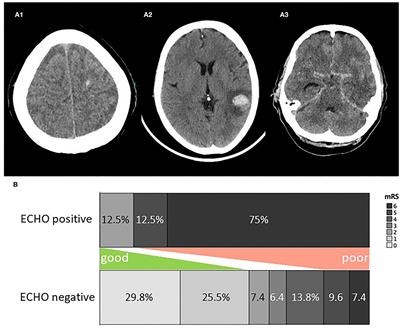 Early Intracranial Hemorrhage Predicts Poor Clinical Outcome in Community-Acquired Bacterial Meningitis